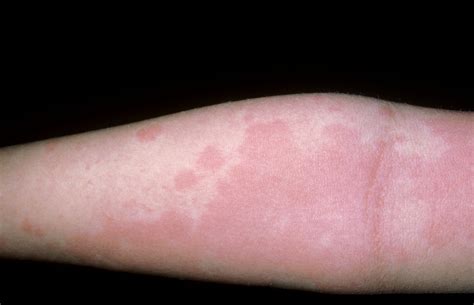 skin rash with ozempic