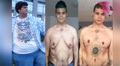 Revolutionizing Body Contours: The Truth About Skin Removal Surgery