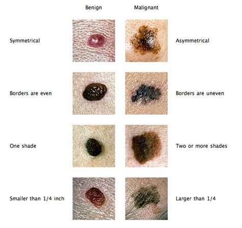skin tag vs skin cancer
