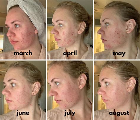 The Changes I Made To My Previous Hormonal AcneProne Skincare Routine
