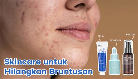 Skincare Untuk Bruntusan