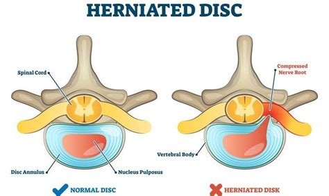 Sky Hard Disc Problem