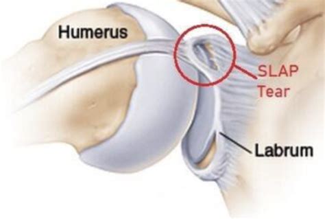 Understanding and Managing Slap Tear Shoulder: Causes, Symptoms, and Effective Treatments