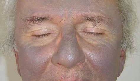 Slate Grey Skin Gray Nevi (Mongolian Blue Spots) Definition, Causes