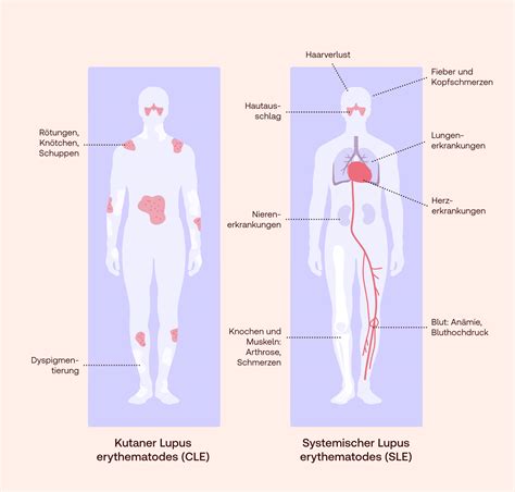 sle autoimmunerkrankung