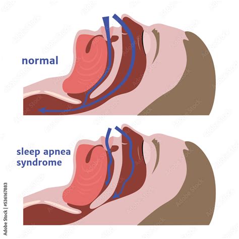 Sleep Apnea Definition