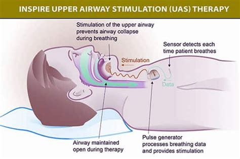 sleep apnea implant how does it work