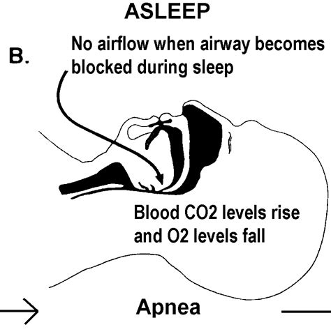 sleep apnea patient info