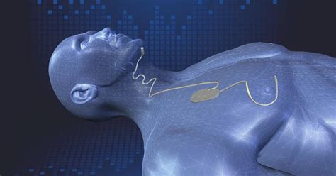 sleep apnea surgical implant