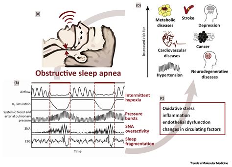 sleep apnea syndrome sas