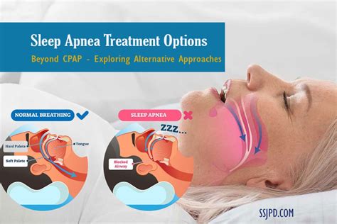 sleep apnea treatments