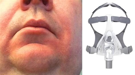 Sleep Mask Causing Red Eyes