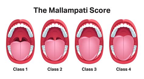 sleep score for sleep apnea