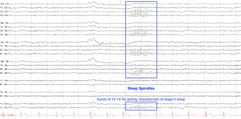 Sleep Spindles On Eeg