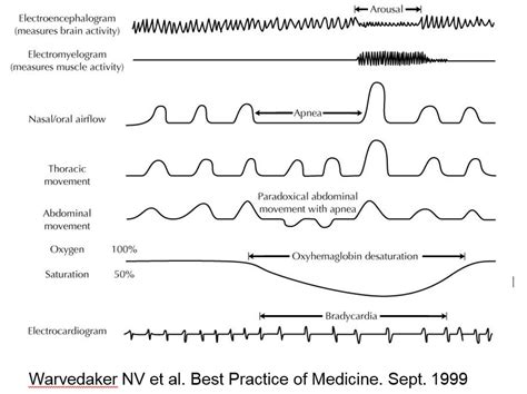 sleep study arousal scoring