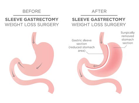 Sleeve Gastrectomy Image