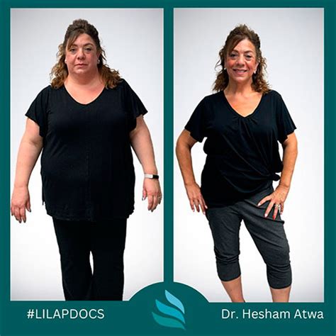 Sleeve To Bypass Revision Before And After