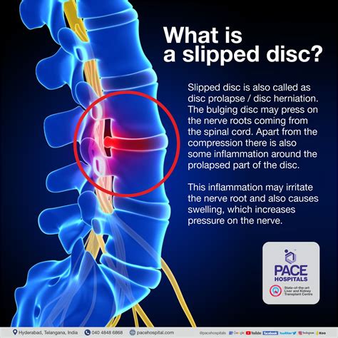 Slip Disc Problem Treatment