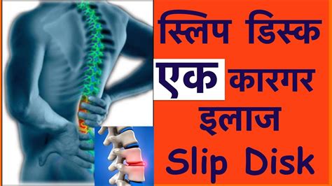 Slip Disk Exercise In Hindi