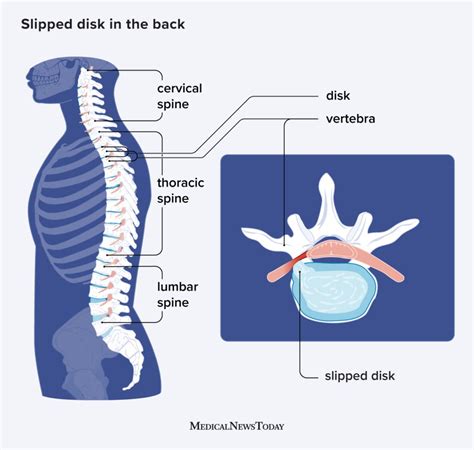 Slipped Disk Causes