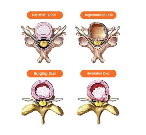 Slipped Disk Flare Up