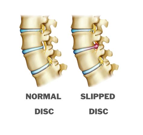 Slipped Disk Vs Back Spasm
