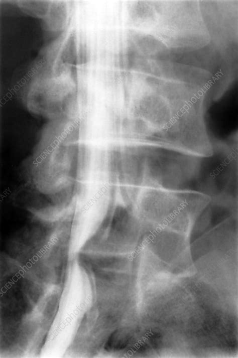 Slipped Disk Xray
