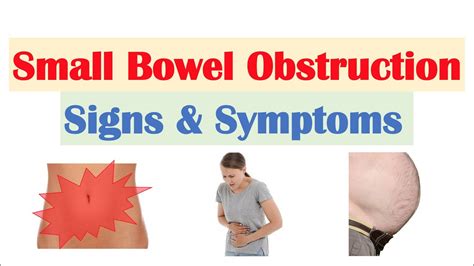Recognizing Small Bowel Obstruction Symptoms: A Medical Emergency