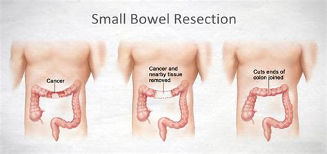 Understanding Small Bowel Resection: Surgical Insights and Recovery Tips
