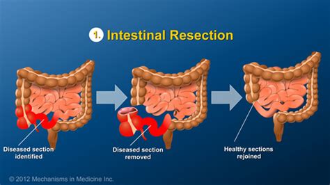 small bowel resection and anastomosis