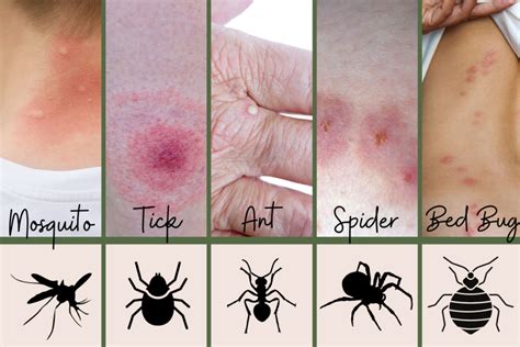 What You Need to Know About Small Bug Bites That Itch and How to Treat Them Effectively