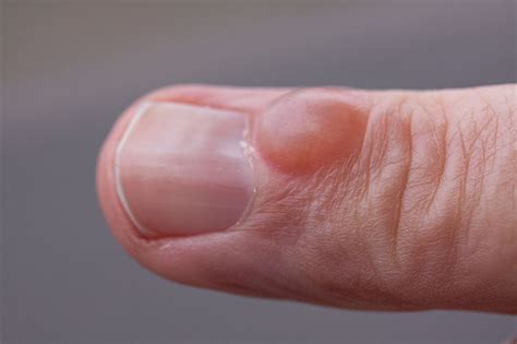 small bumps near fingernails
