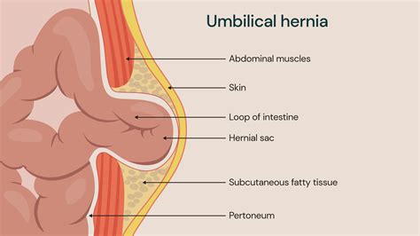 Managing Small Fat Containing Umbilical Hernia Effectively