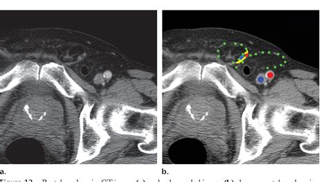 small inguinal hernia radiology