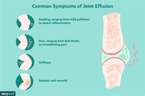Understanding Small Joint Effusion: Causes, Symptoms, and Effective Treatment Options