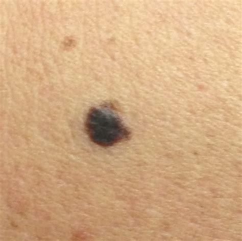 small melanoma on arm