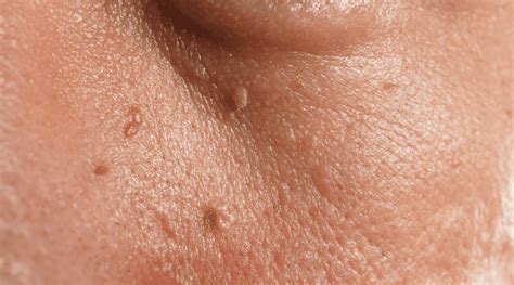 Removing Small Skin Tags: What You Need to Know