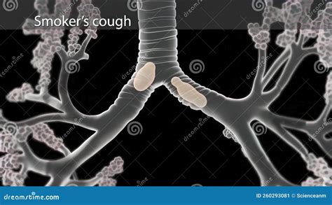 Smokers And Bronchitis