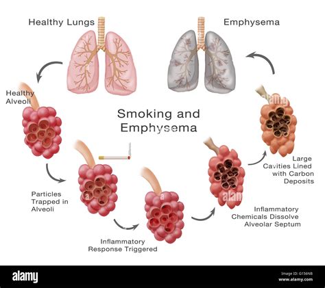 Smoking Lung Emphysema