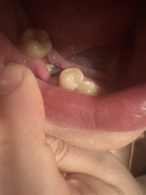 Smoking Through Nose Dry Socket Reddit