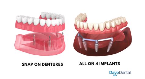 Snap-In Removable Dentures Cost