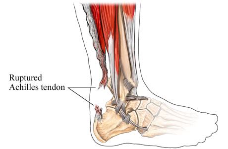 Understanding the Devastating Impact of a Snapped Achilles Tendon