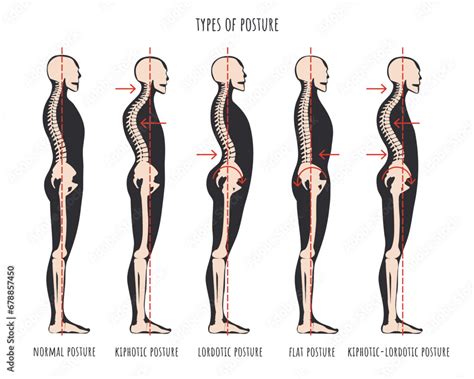 Snapped Neck Definition