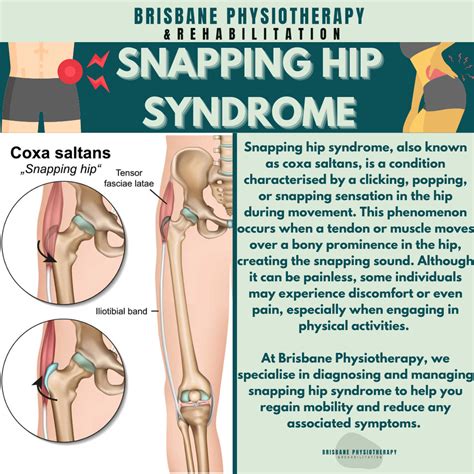 Understanding Snapping Hip Syndrome: Causes and Effective Treatments