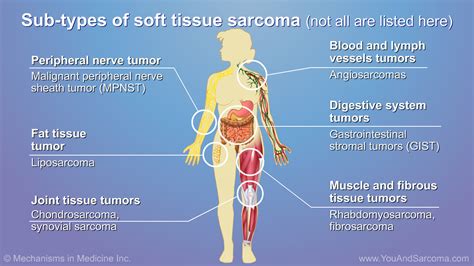soft tissue sarcoma cancer