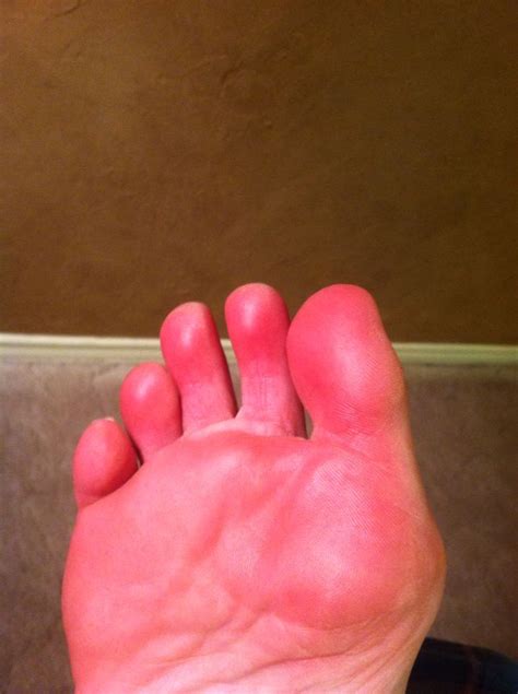 Sole Of Feet Bright Red
