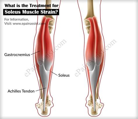 Soleus Muscle Hurts