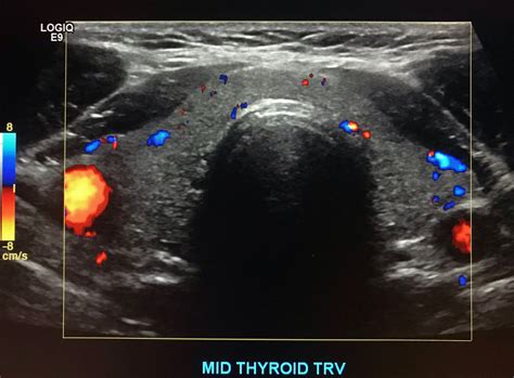 Sonography of Thyroid: Accurate Diagnosis through Ultrasound Imaging