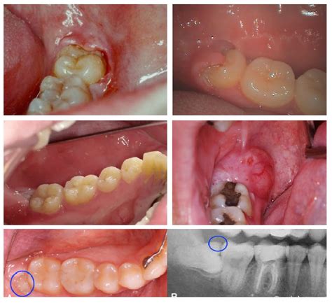 sore impacted wisdom tooth