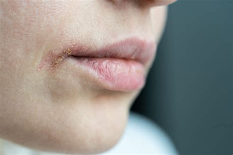 Sore Lips Eczema